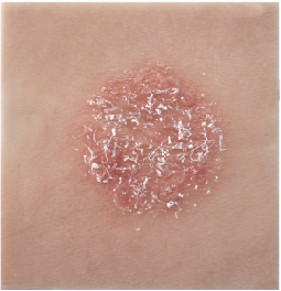 GD Skin Fungal Infection Training Patch (Tinea corporis)